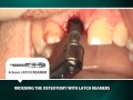 Placement and restoration of a bicon max 25 implant