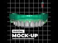 Upper dental veneers    qualident dental lab