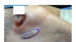 Nasal Valve Surgery – Functional Rhinoplasty in San Francisco – Dr. David Kim
