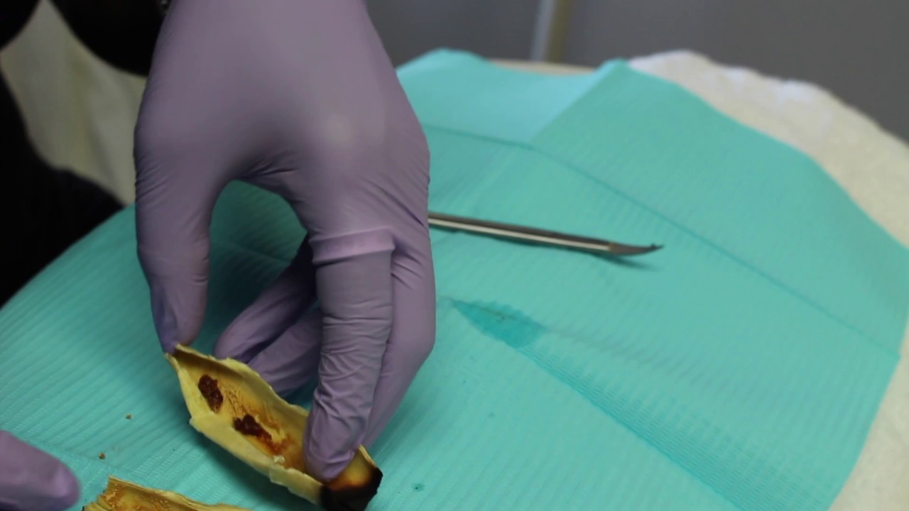 Ear Candling YouTube