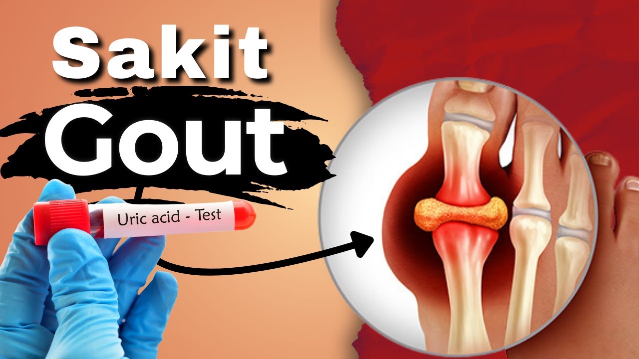 Sakit Gout | 5 Makanan Punca Utama Wajib Elak | Doctor Sani |