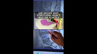 MRI reveals sciatica: disc on nerve—decompression eased pressure, pain free #SciaticaRelief