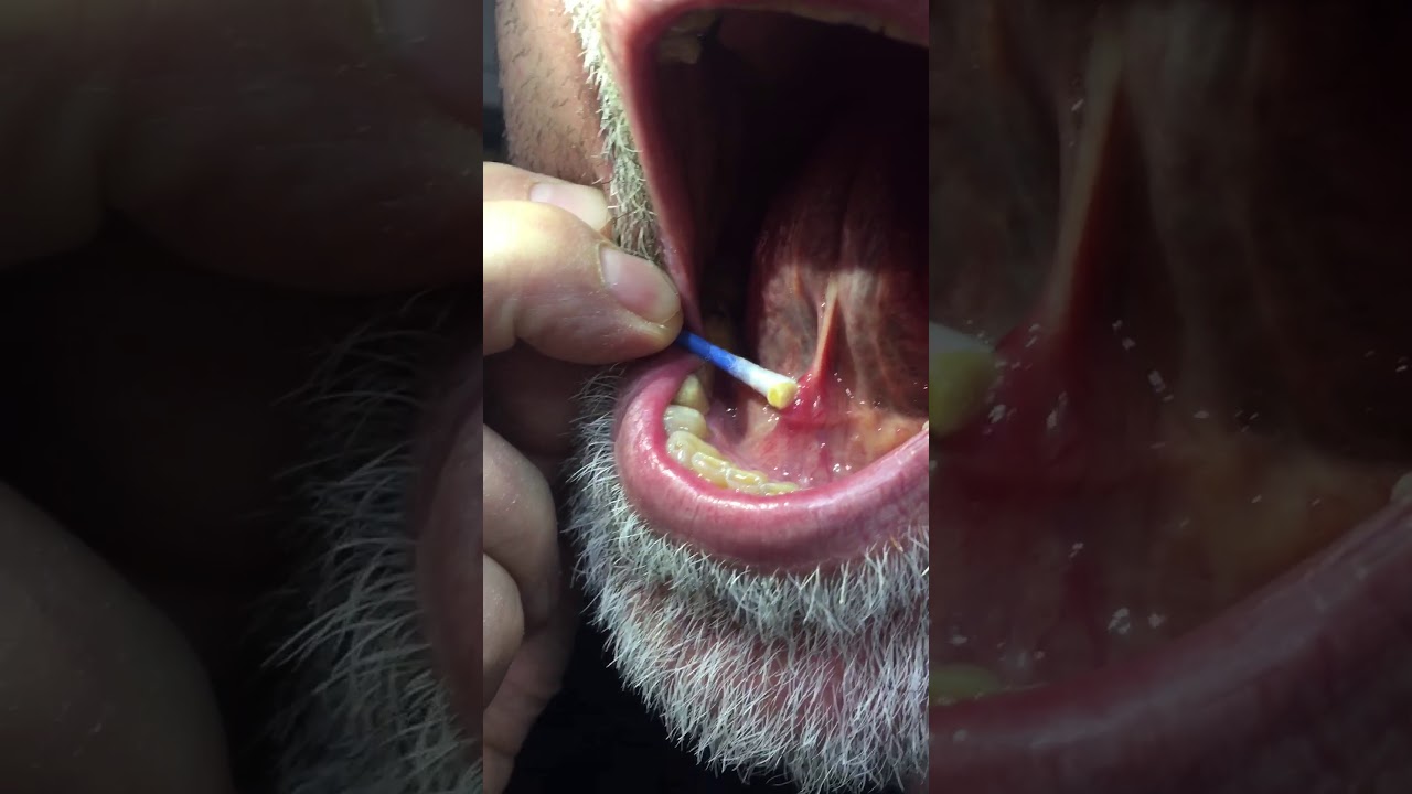 Salivary Stones Removal Vađenje Kamena Iz žlijezde Slinovnice Youtube