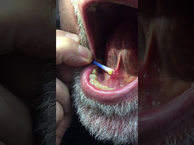 Navel Stones To Ingrown Toenails Can You Handle Youtube S