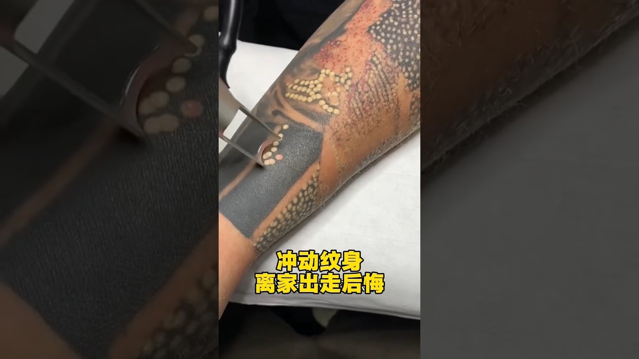 Laser Se Tattoo Remove Karte Hue | Real Experience