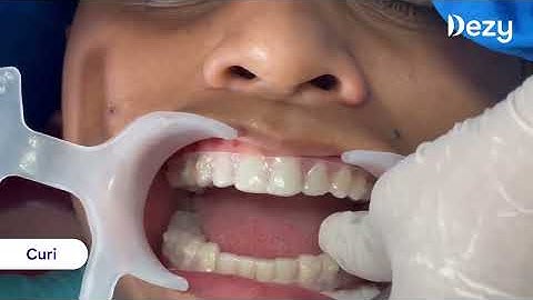 Dezy Clear Aligners | Interproximal Reduction (IPR) and Attachments | Teeth Aligners
