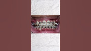 Đây là cách niềng răng hoạt động | Nha Khoa ViDental #shorts #fyp #xuhuong #niengrang #trending