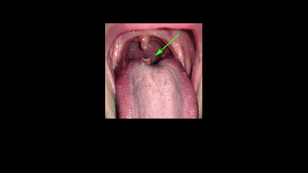ENT Strange Factoids The It Is Abnormal But Actually Normal Epiglottis Shorts Fauquierent