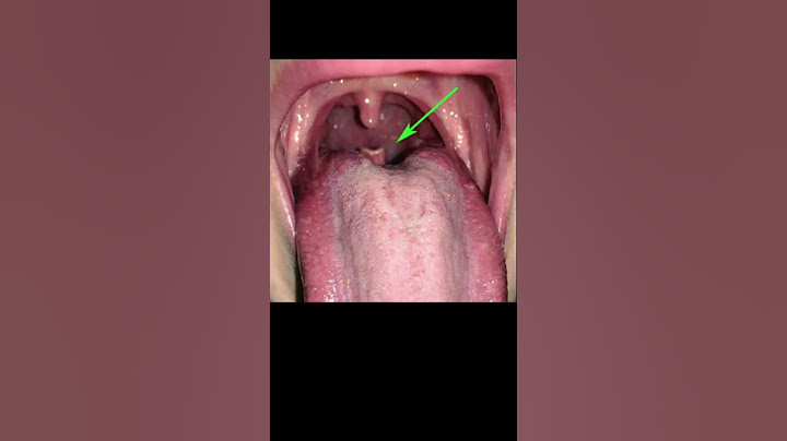 ENT strange factoids. The “It is abnormal!” But is actually normal epiglottis #shorts @fauquierent