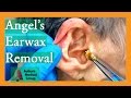 Angel's Earwax Removal | Auburn Medical Group