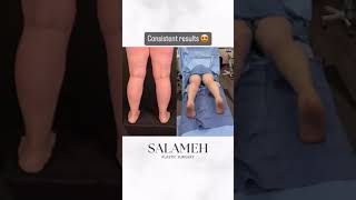 Before And Afters Lippylipo Treatment For Lipedema