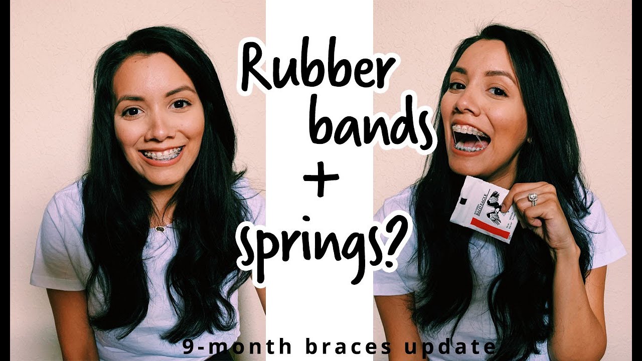 RUBBER BANDS + SPRINGS 9month braces update YouTube
