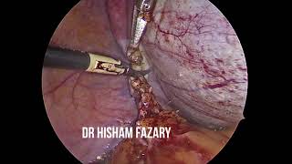 huge dermoid 20 cm, left oophorectomy