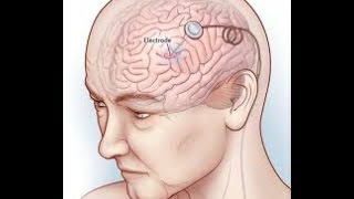 Deep Brain Stimulation Stage 2 Prof. R Bittar  Melbourne Deep Brain Stimulation