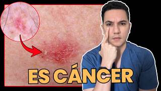 Pensaban que era psoriasis o una infección por hongo pero era cáncer de piel | Dr. William Guerrero