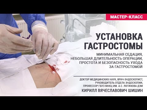 Установка гастростомы