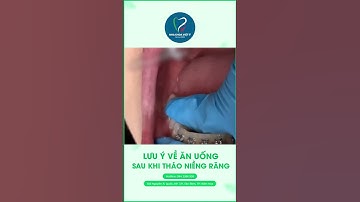 Lưu Ý Về Ăn Uống Sau Khi Tháo Niềng Răng
