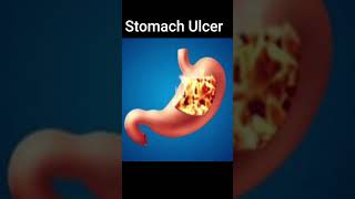 Stomach Ulcer | What Can Cause Stomach Ulcer shorts shorts shortsvide stomachulcer