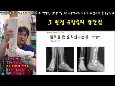 209.(환자용.발목 관절염 치료 설명 1~4) 3 관절 유합술의 장단점 [강찬.충남대.Chan KANG]