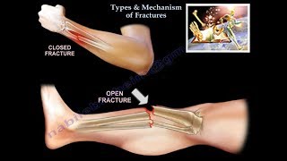 Types \u0026 Mechanism Of Fractures  - Everything You Need To Know - Dr. Nabil Ebraheim