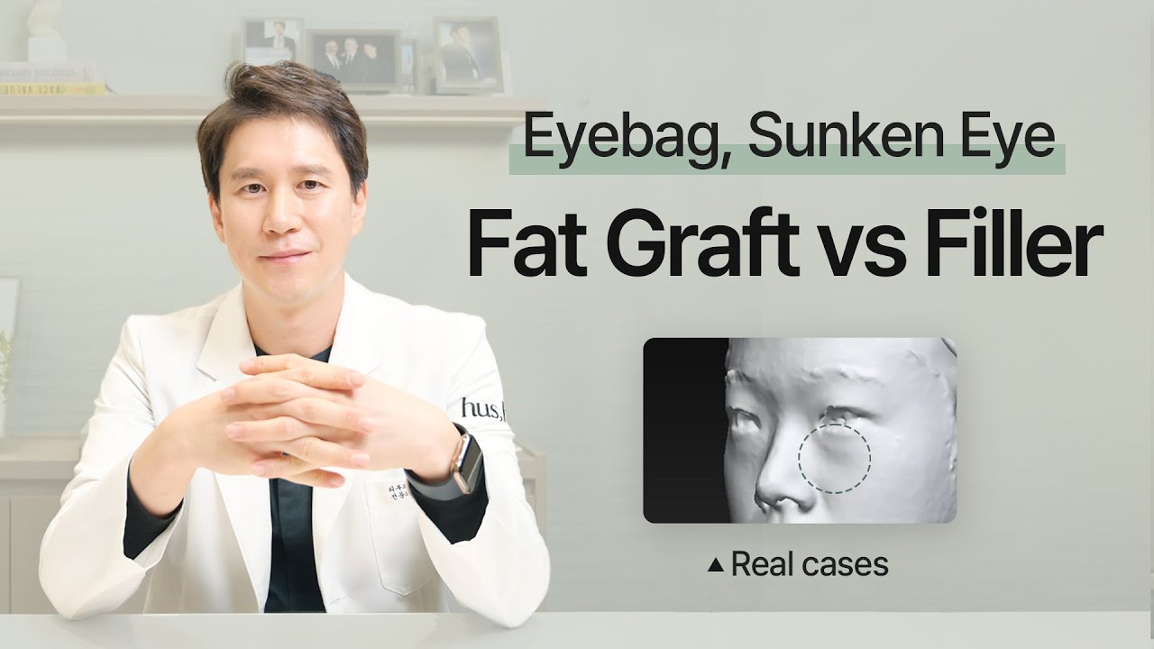 Fat Graft vs Filler for Eyebags and Sunken Eyes YouTube