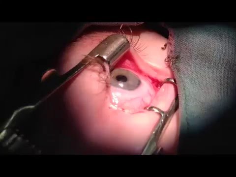 Eye Surgery. Conjunctivodacryocystorhinostomy. Офтальмохирург профессор Бржеский В.В.