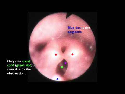 Laryngomalacia - The Floppy Airway