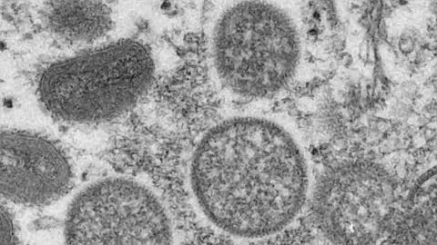 Watch: Health officials provide update on monkeypox outbreak in King County