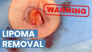 Lipoma Removal and Cyst Extraction by Dr. Timothy Jochen | CONTOUR DERMATOLOGY