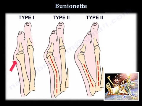 Video: Ist die Bunionette-Operation von der Versicherung abgedeckt?