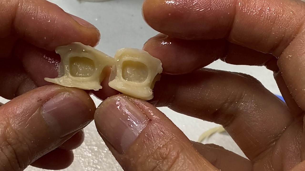 [실험1-2] 임시치아 구강에서 꺼내는 시기는?