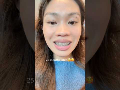 I M So Happy About How My Smile Changed Four More Months To Go Before I M Done With The Braces 