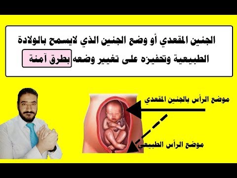 الجنين المقعدي أو وضع الجنين الذي لايسمح بالولادة الطبيعية وتحفيزه على تغيير وضعه بطرق آمنة