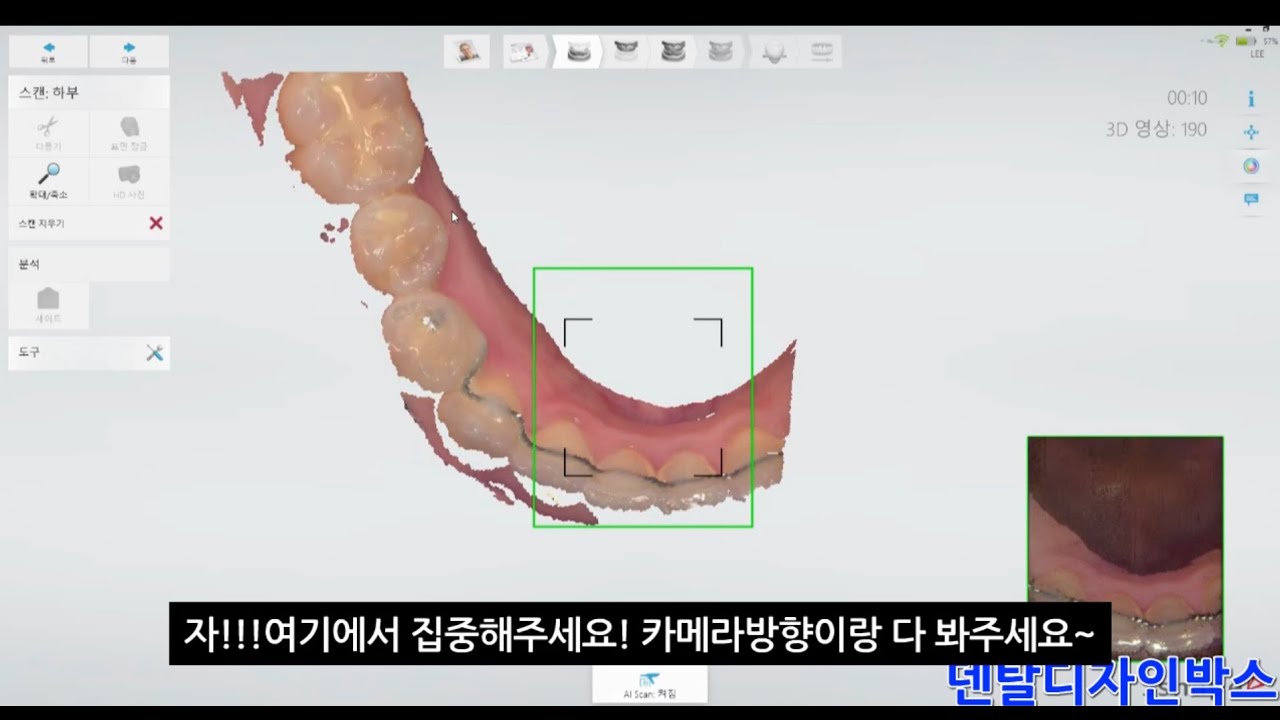 구강스캐너 노하우2편_서지컬가이드 제작할 때 스캔은 어떻게 하나요? Trios3, I500, 프라임스캐너로 구강스캔하여 디오나비,네비게이션,오스템 원가이드 의뢰하기~