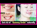 Just 4 steps! How to get rid of Gummy Smile naturally. No braces or Surgery | Gummy smile exercises.