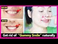 Just 4 Steps How To Get Rid Of Gummy Smile Naturally No Braces Or Surgery Gummy Smile Exercises 