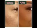 ( Pain in the ASS !! ) Pitted Acne Scars...How i minimize appearance with foundation