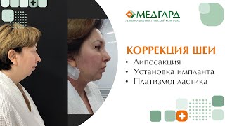 Коррекция шеи. Клиника Медгард-Саратов