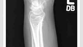 Distal Radius Fractures: ER management, Reduction, and Tips