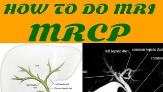 HOW TO DO MRI MRCP