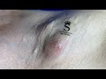 Cyst On A Woman's Armpit | Mụn Nhọt Trên Nách - SacDepSpa#289