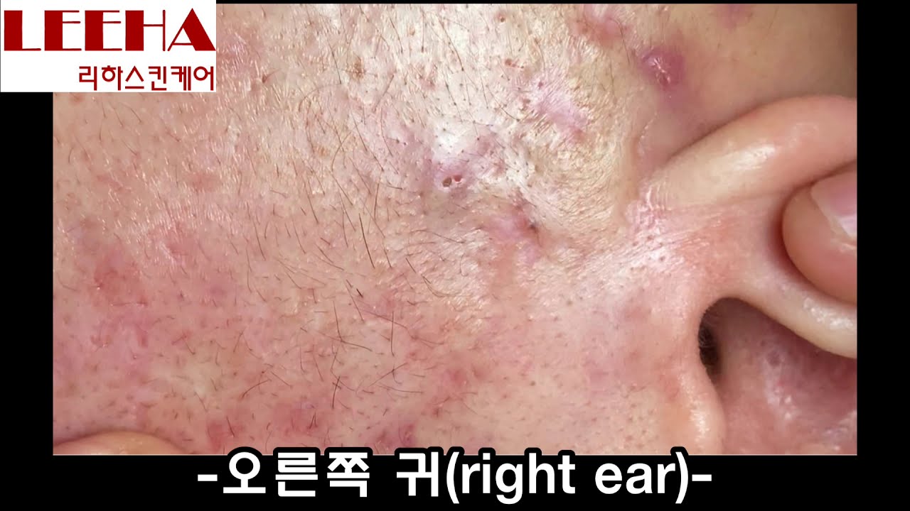 거제 여드름 짜기 확대 영상! 무제한 반복 재미☆