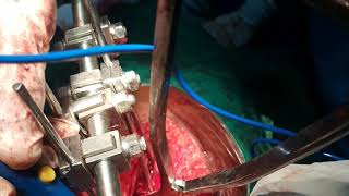 Sub-Trochanteric Fracture Femur Pseudarthrotic Case Treated Adamya Hospital Videos