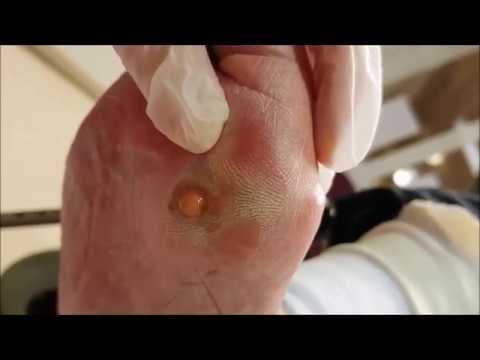 Video: Behandling av tåneglssopp med folkemedisiner