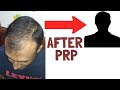 Prp results 2020  hair loss treatment  hair fall