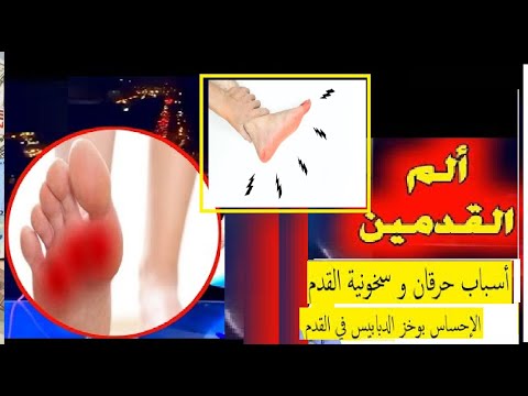 أسباب حرقان و سخونية القدم حرقان و وخز في القدم