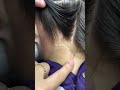 liceinfestation579 #headliceremoval #licecomb #headlice #headlicetreatment #hairlice #haircare #hair