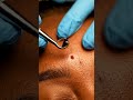 😲 Watch This Eyebrow Blackhead Emerge Satisfyingly