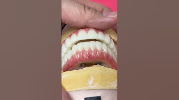 Full Mouth PMMA Provisionals