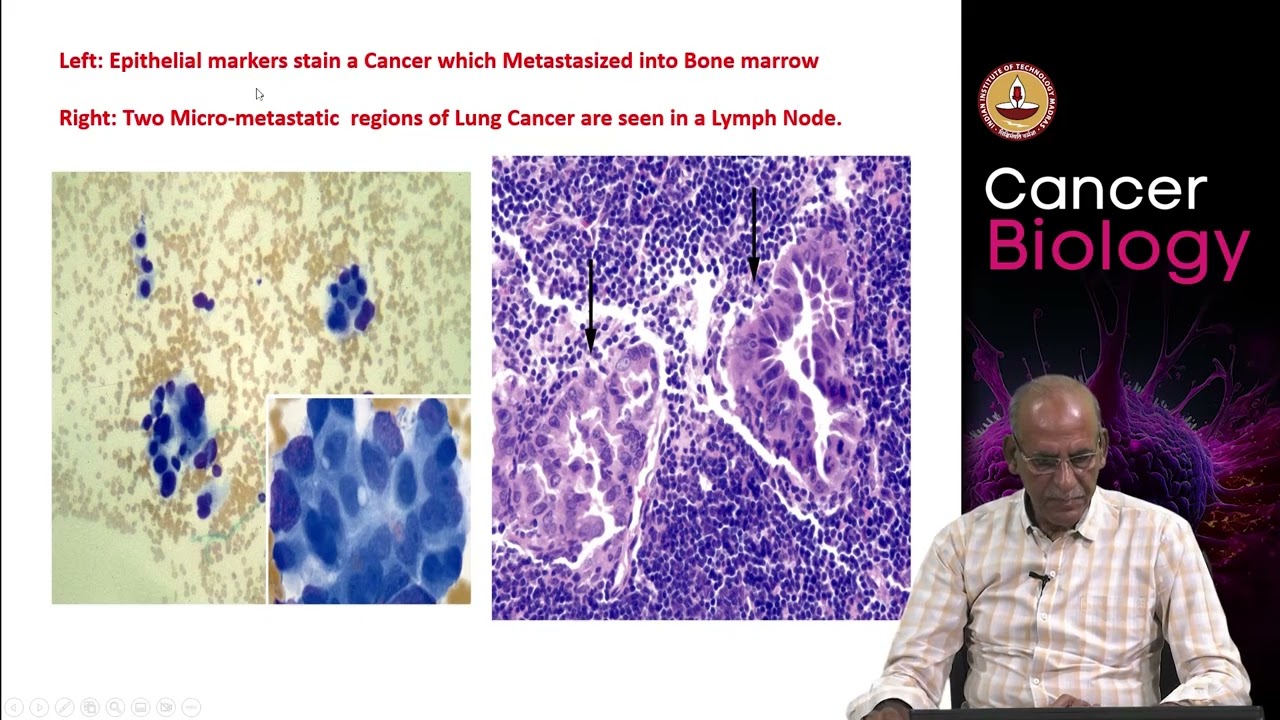 Metastasis and epithelial mesenchymal transition